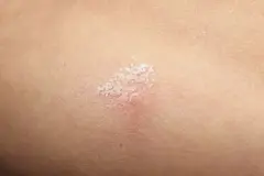 Salz gegen M&uuml;ckenstiche