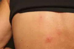 Aspirin gegen Wespenstiche