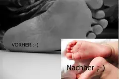 F&uuml;&szlig;e ohne Hornhaut