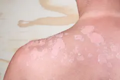 Achtung UV: Die 7 besten Tipps gegen Sonnenbrand