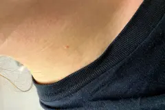 Hom&ouml;opathisches Mittel gegen Warzen aller Art