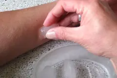 M&uuml;ckenstiche - Soforthilfe